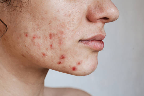 Acne-Prone Skin Essentials